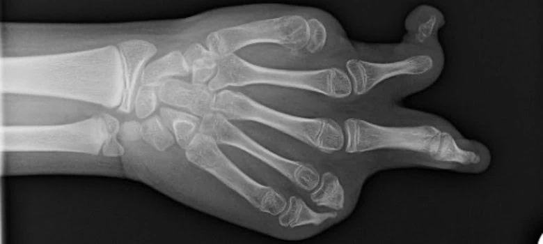 Congenital Defect