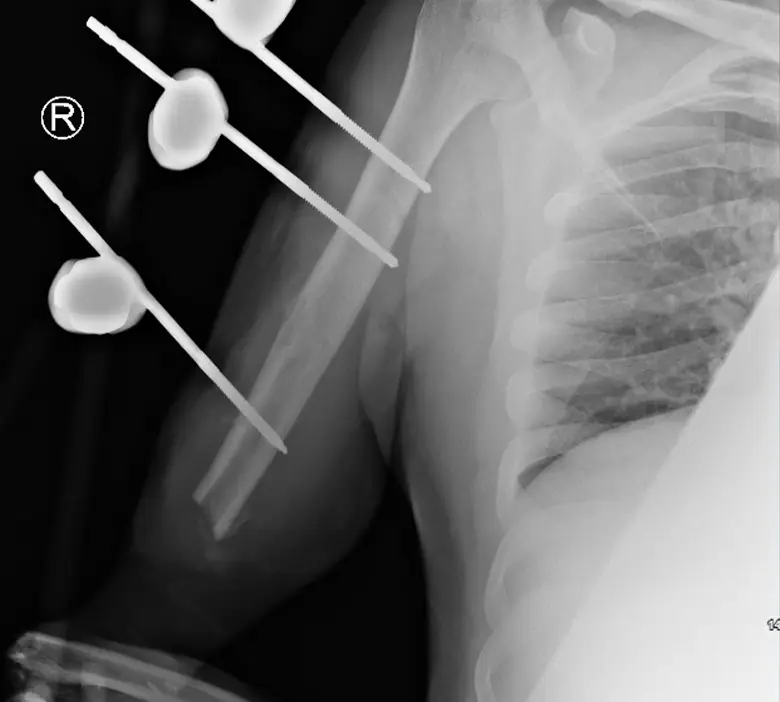 Complex limb reconstruction