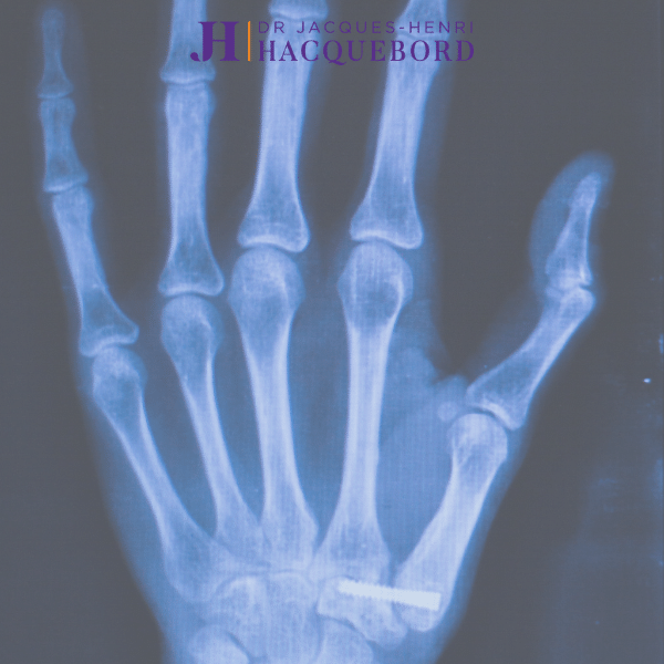 wrist fracture x-ray